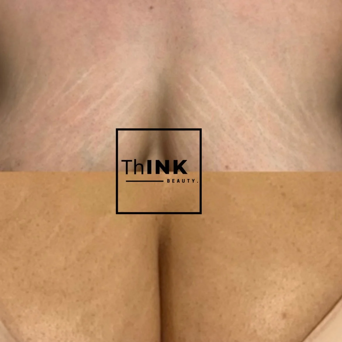 Stretch mark camouflage across the décolleté, before and after