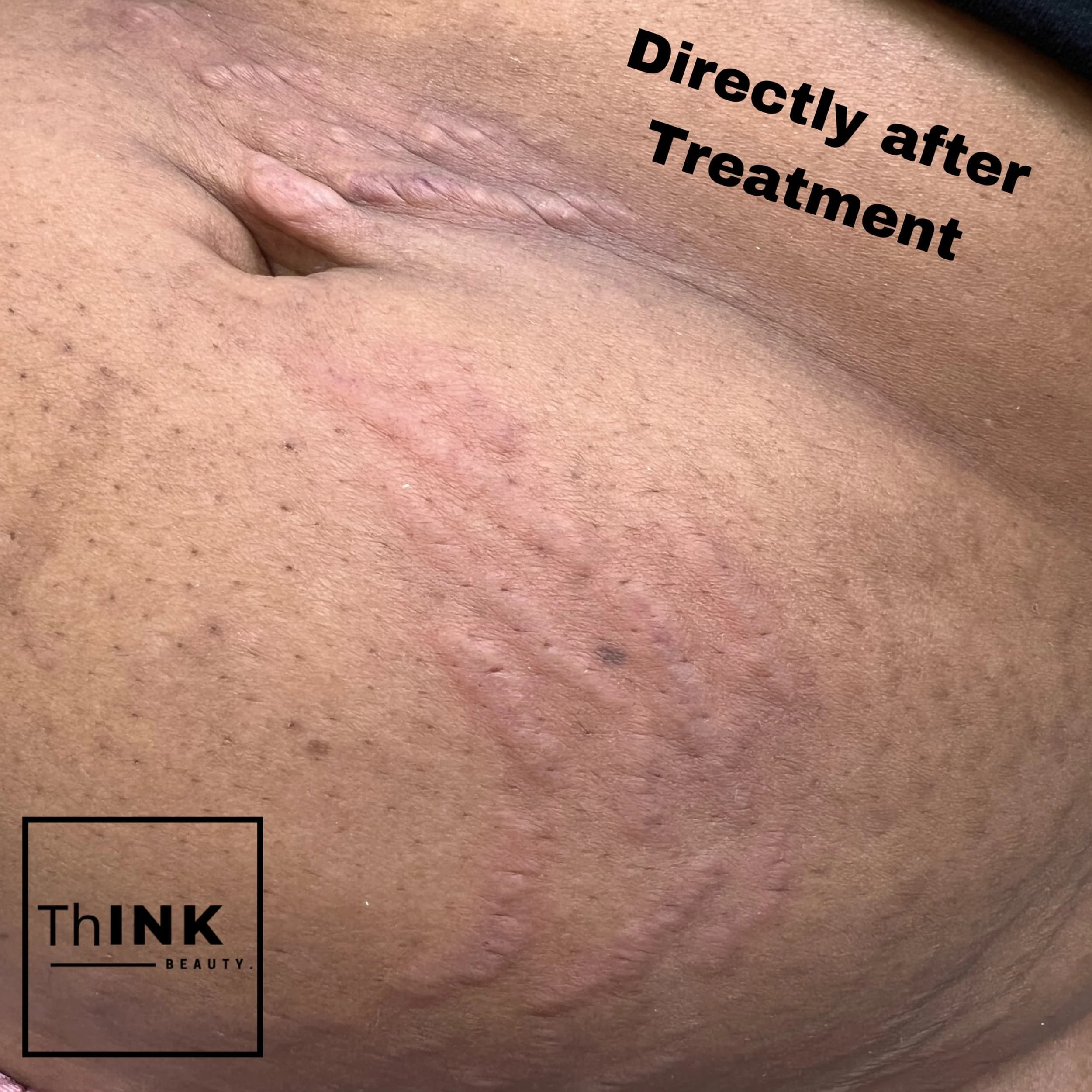 Stretch marks photographed directly after camouflage treatment