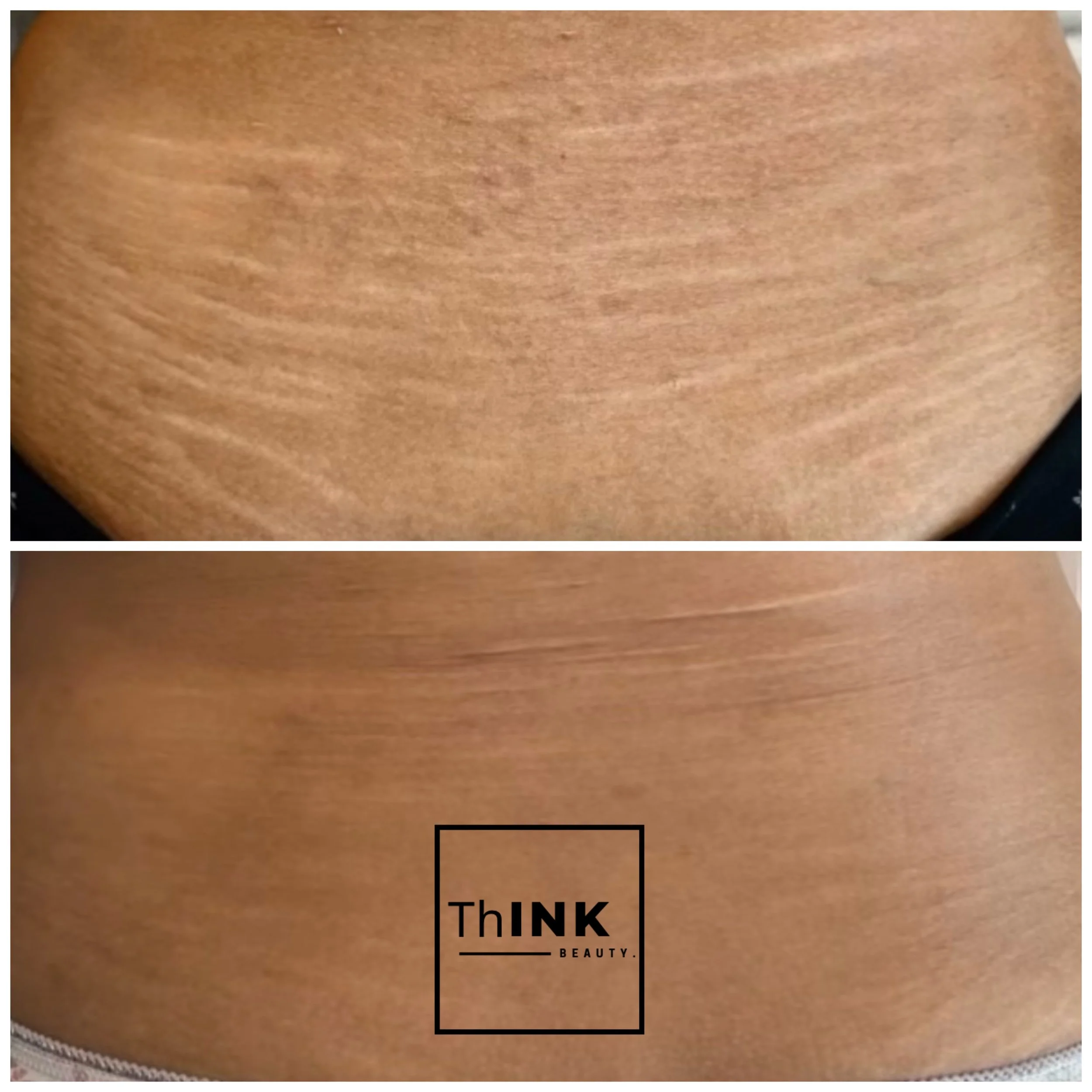 Stretch marks blended into the surrounding skin tone