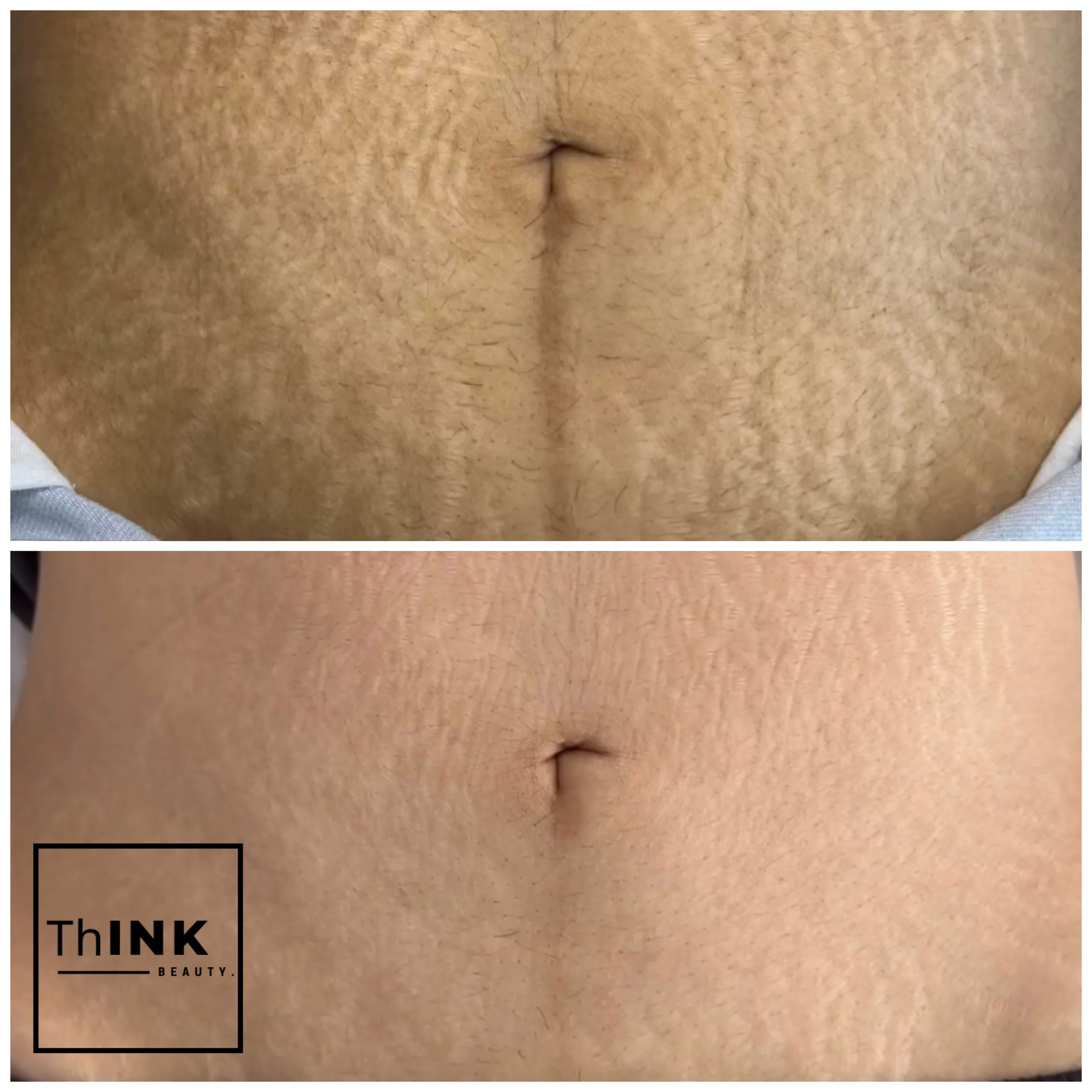 Abdominal stretch mark camouflage, before and after
