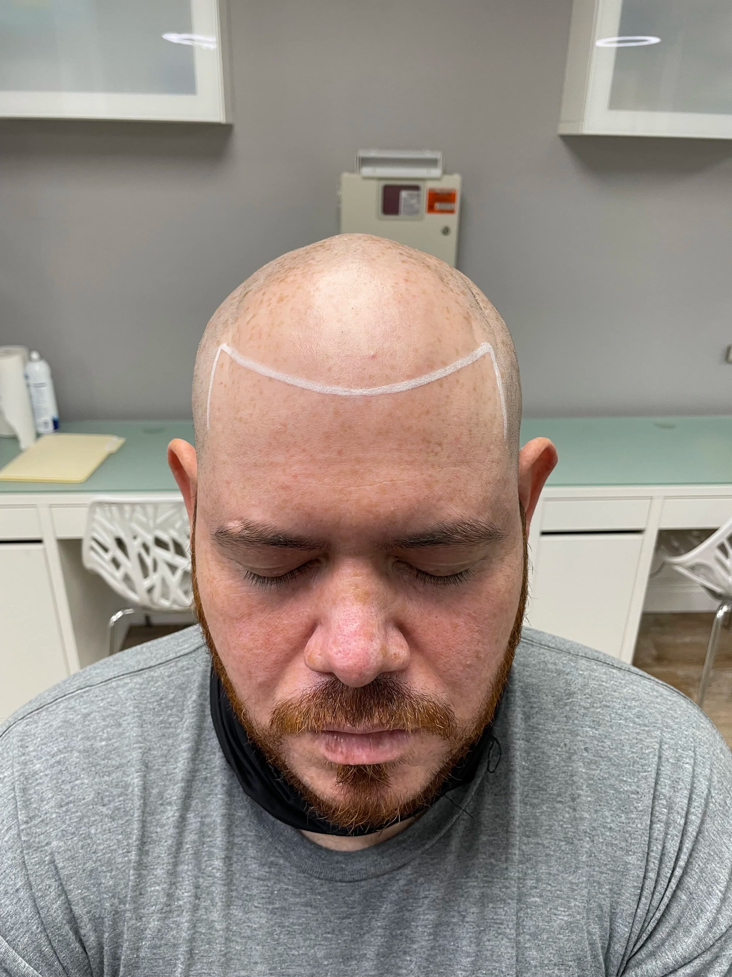 A client's hairline drawn on and agreed before any pigment is placed