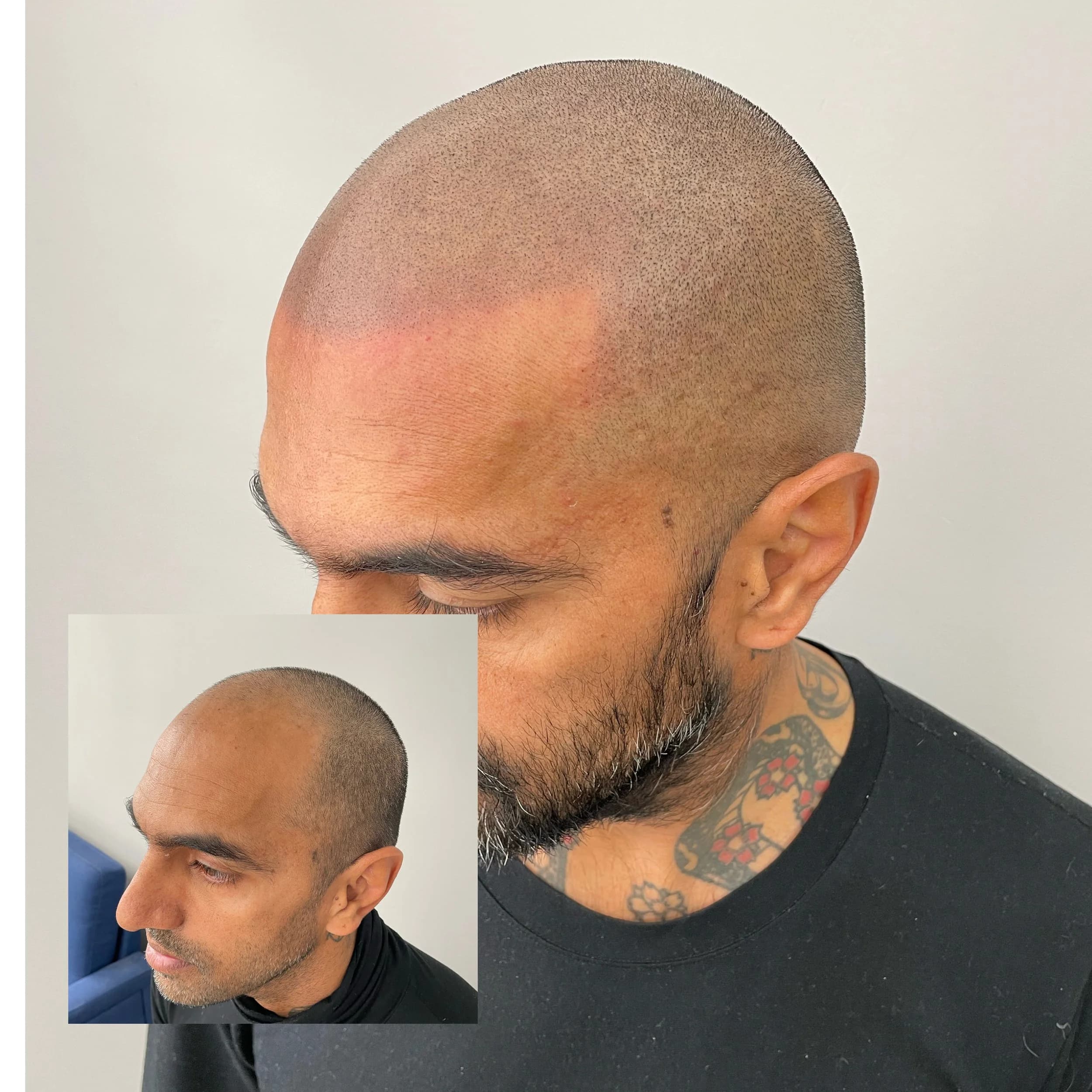 Scalp micropigmentation result with the client's before shot inset