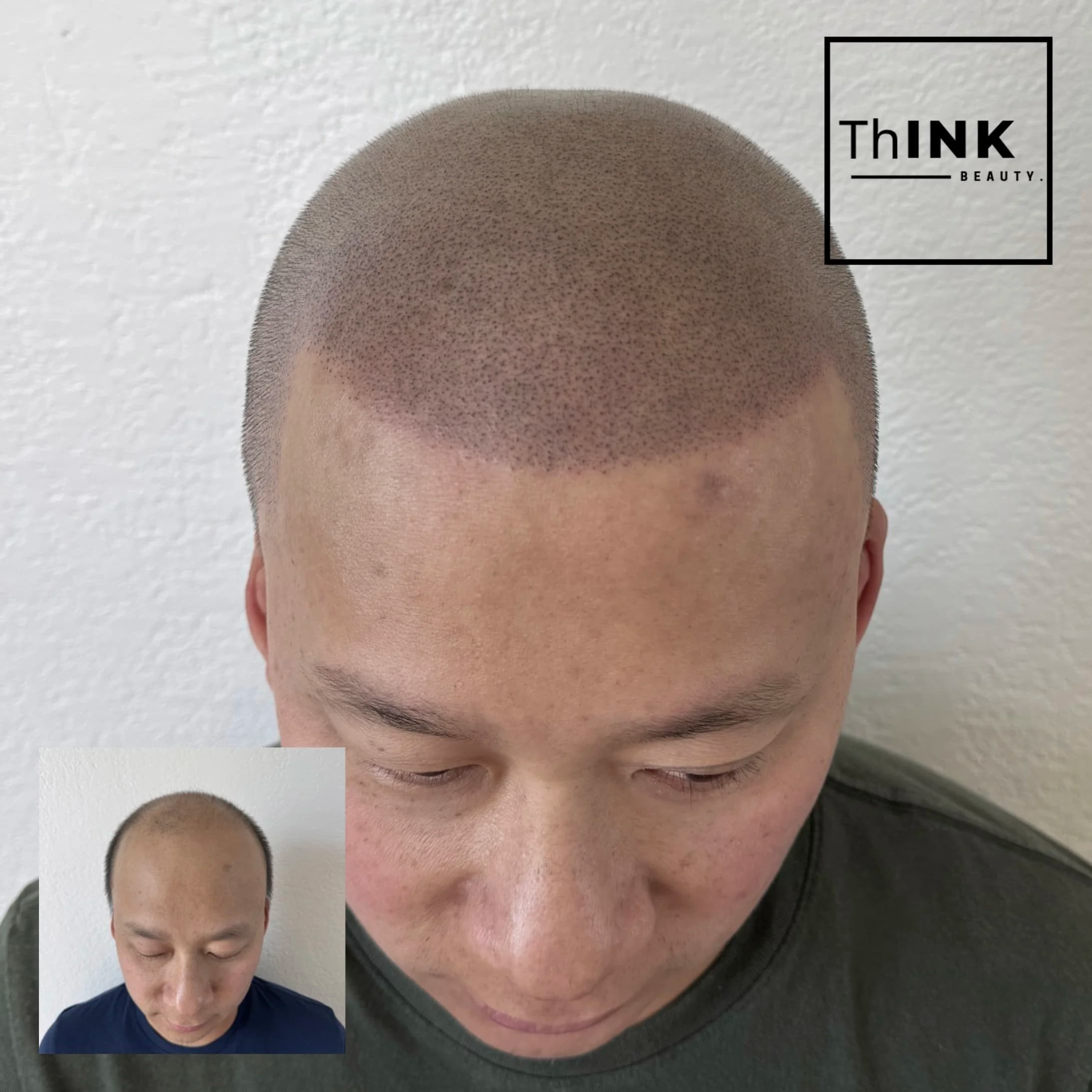 Restored hairline and even crown density after scalp micropigmentation