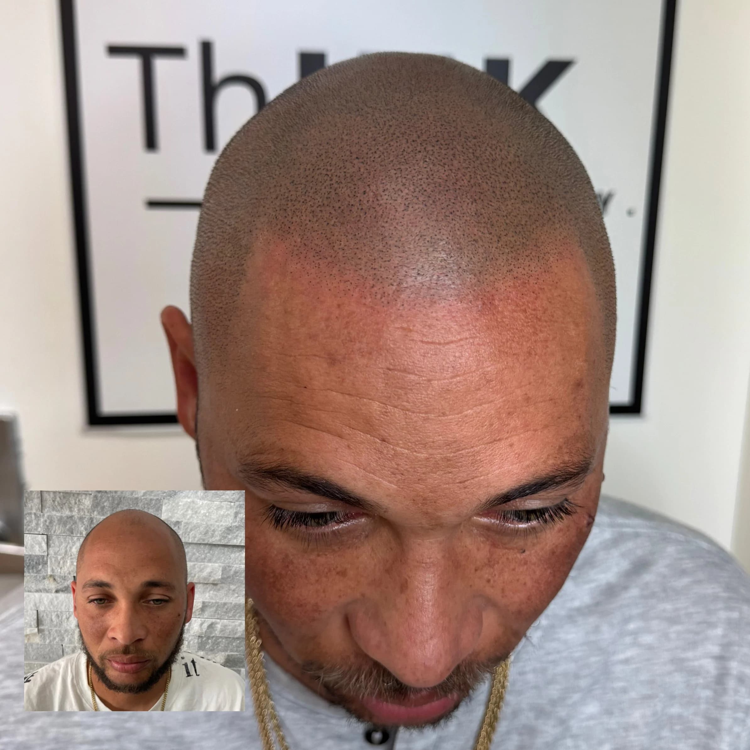 Scalp micropigmentation on a shaved head, before shot inset