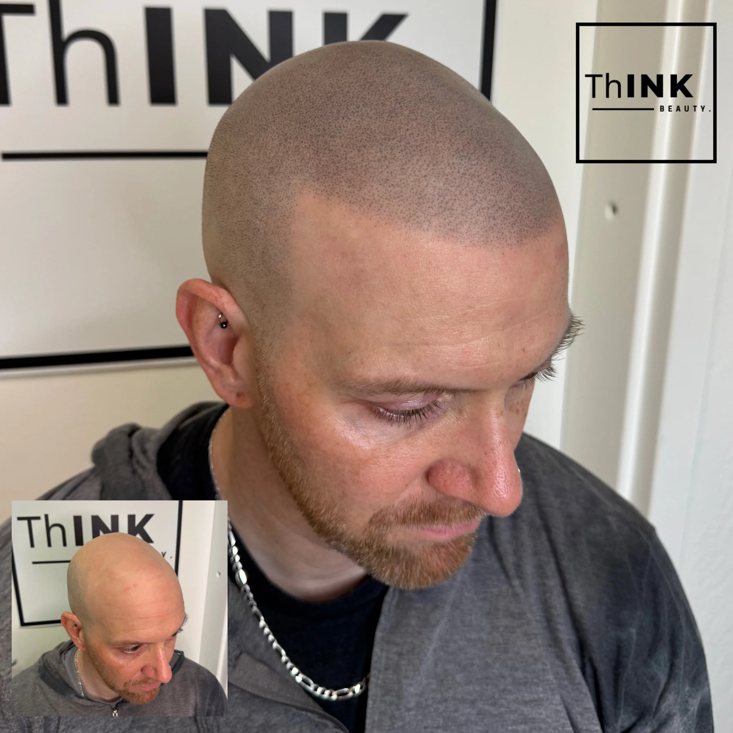 A softly defined SMP hairline on a client with a receded front