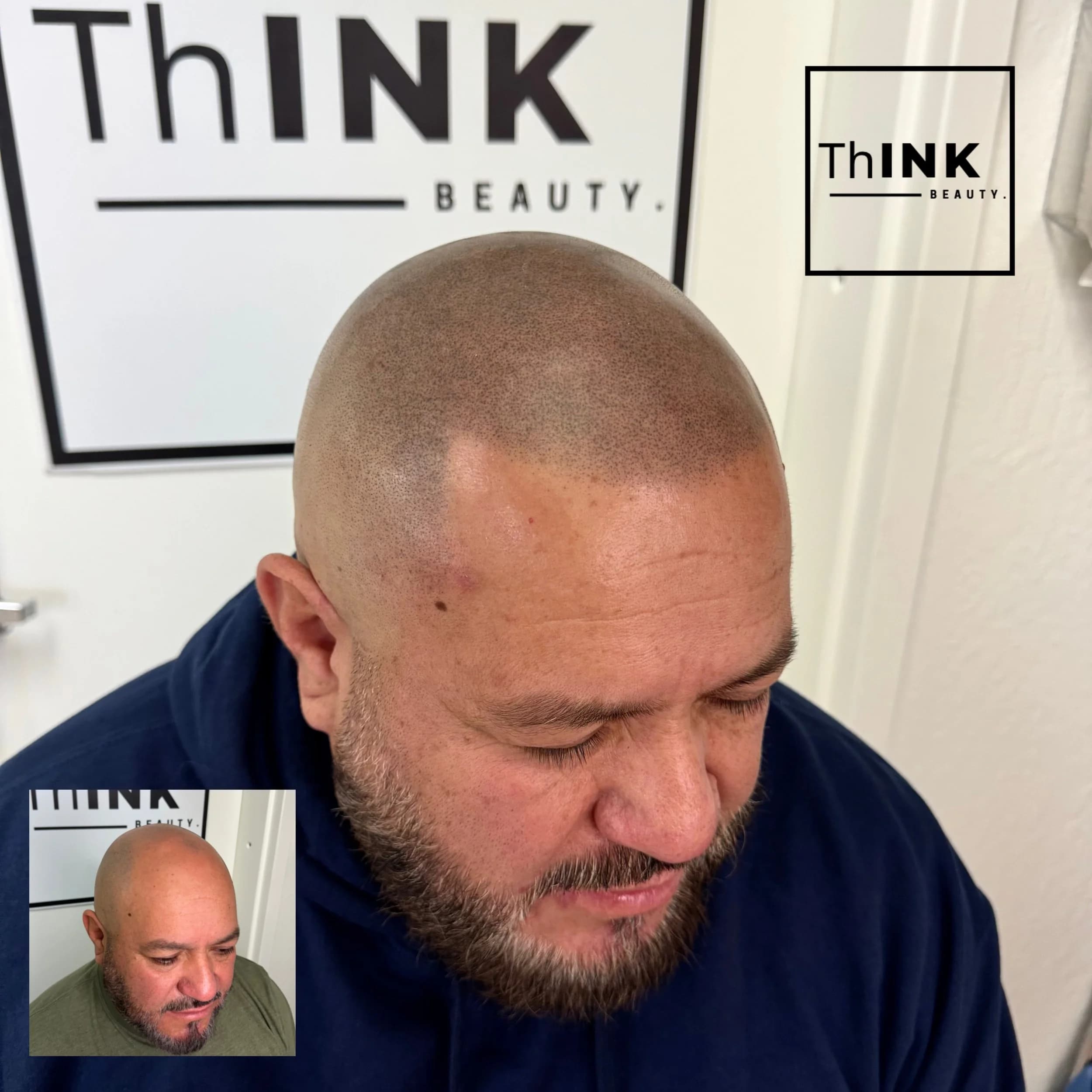 Scalp micropigmentation filling a thinning crown, before shot inset