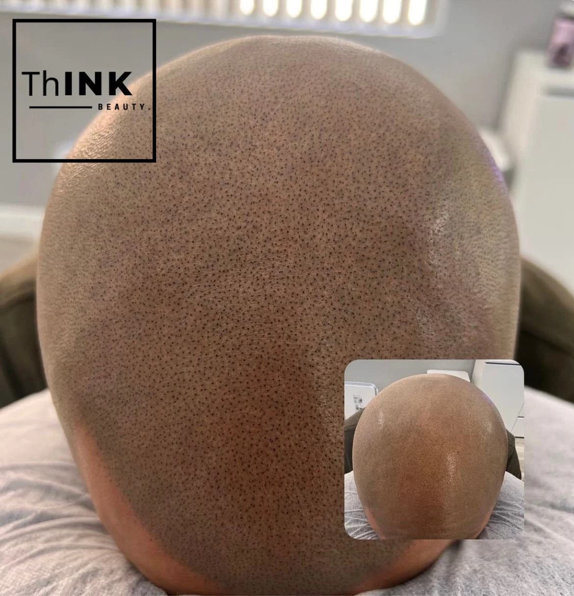 Dense, even scalp micropigmentation across the top of the head