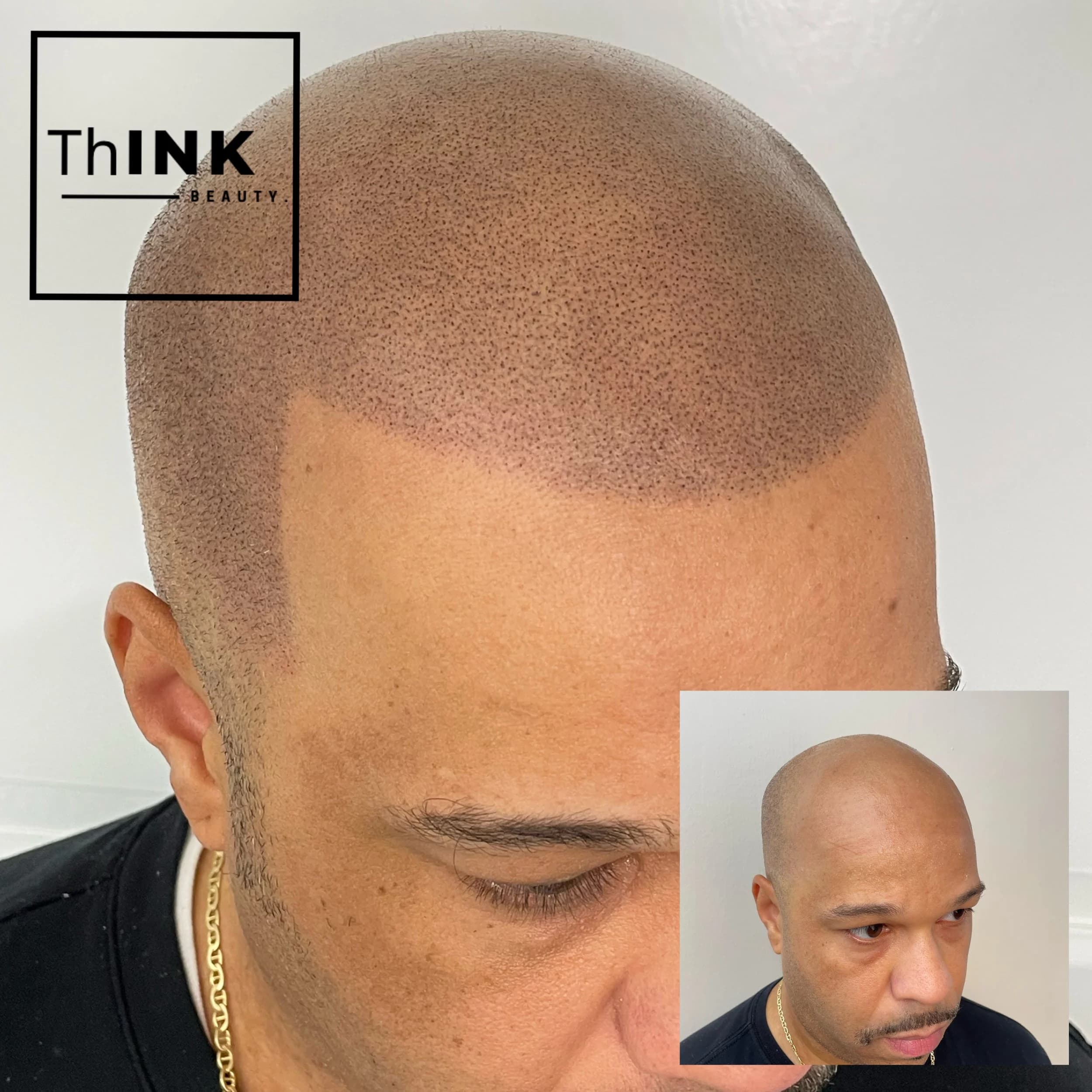 Scalp micropigmentation result on a fully shaved head