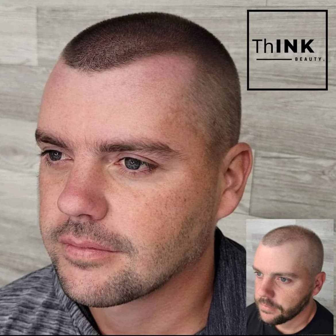 A natural, age-appropriate SMP hairline in profile