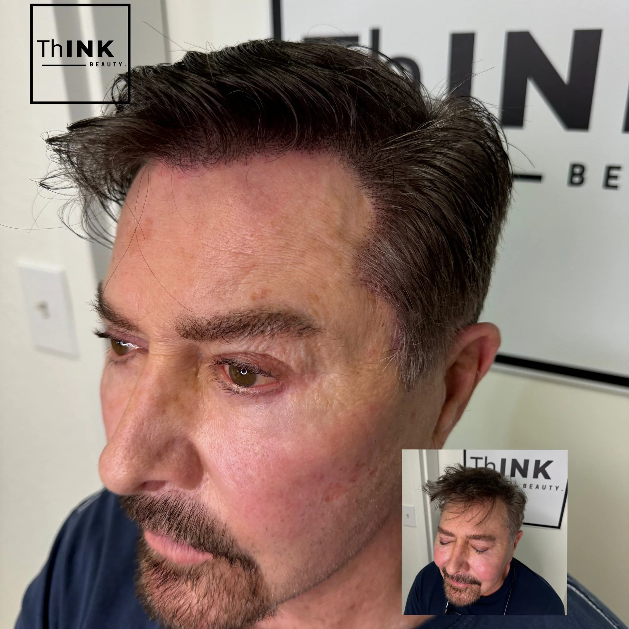 Scalp micropigmentation adding definition to a shaved head