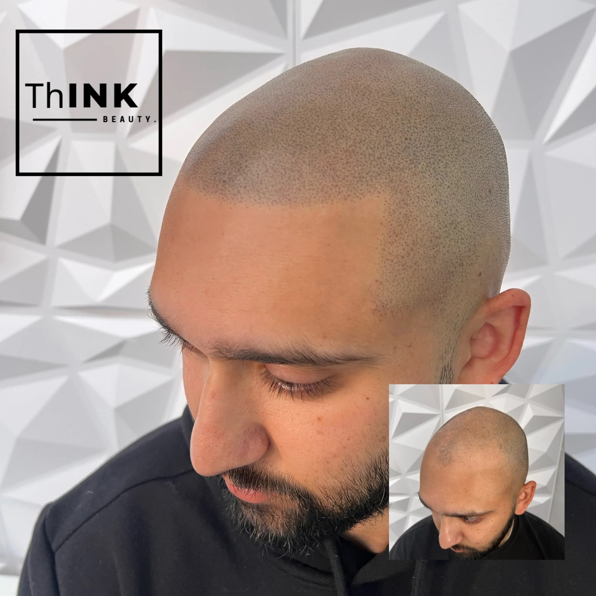 A finished scalp micropigmentation hairline in profile