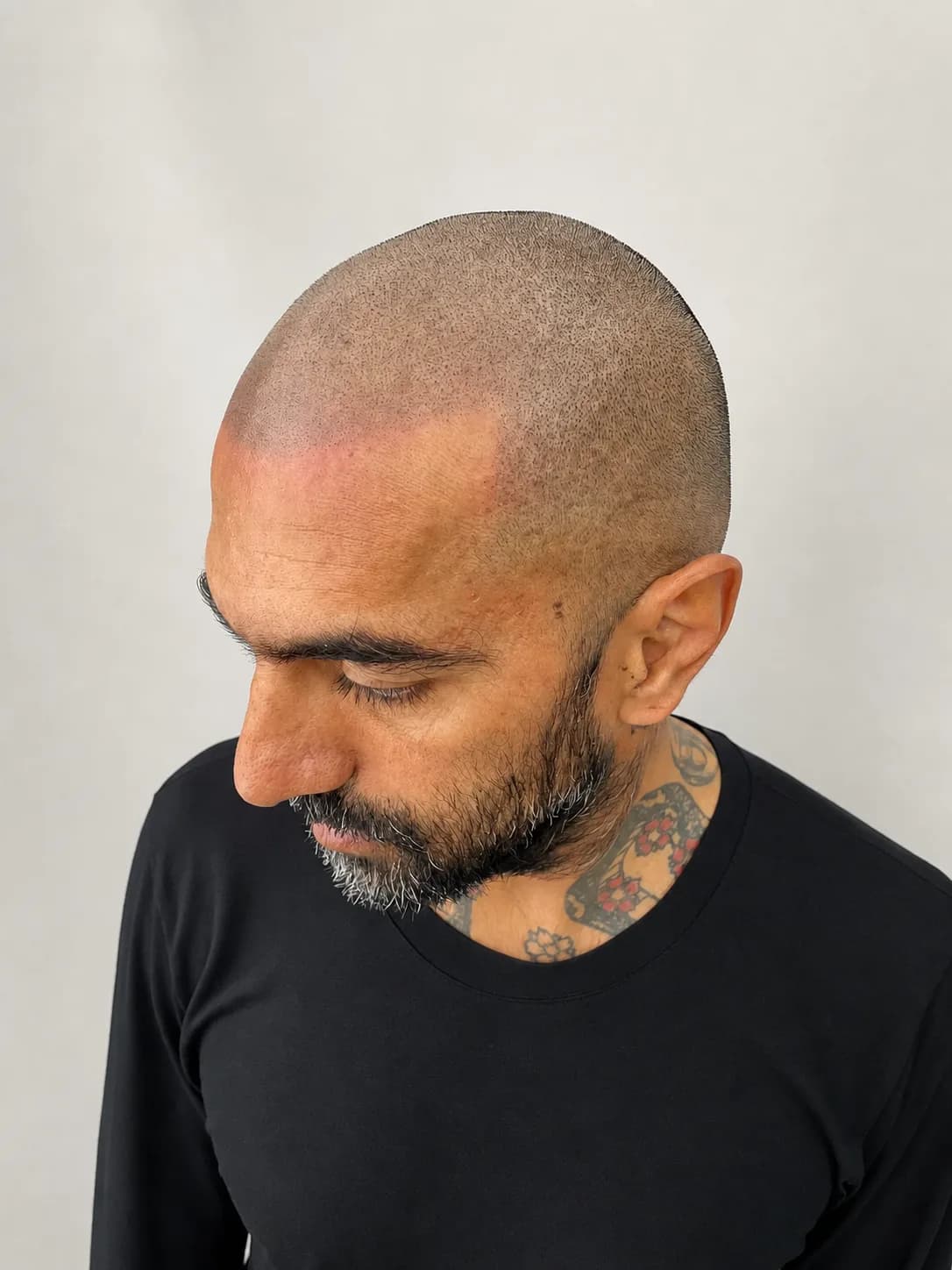 Scalp micropigmentation result with even density across the crown