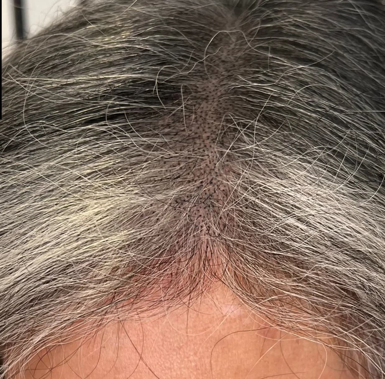 Density restored across a diffuse thinning pattern