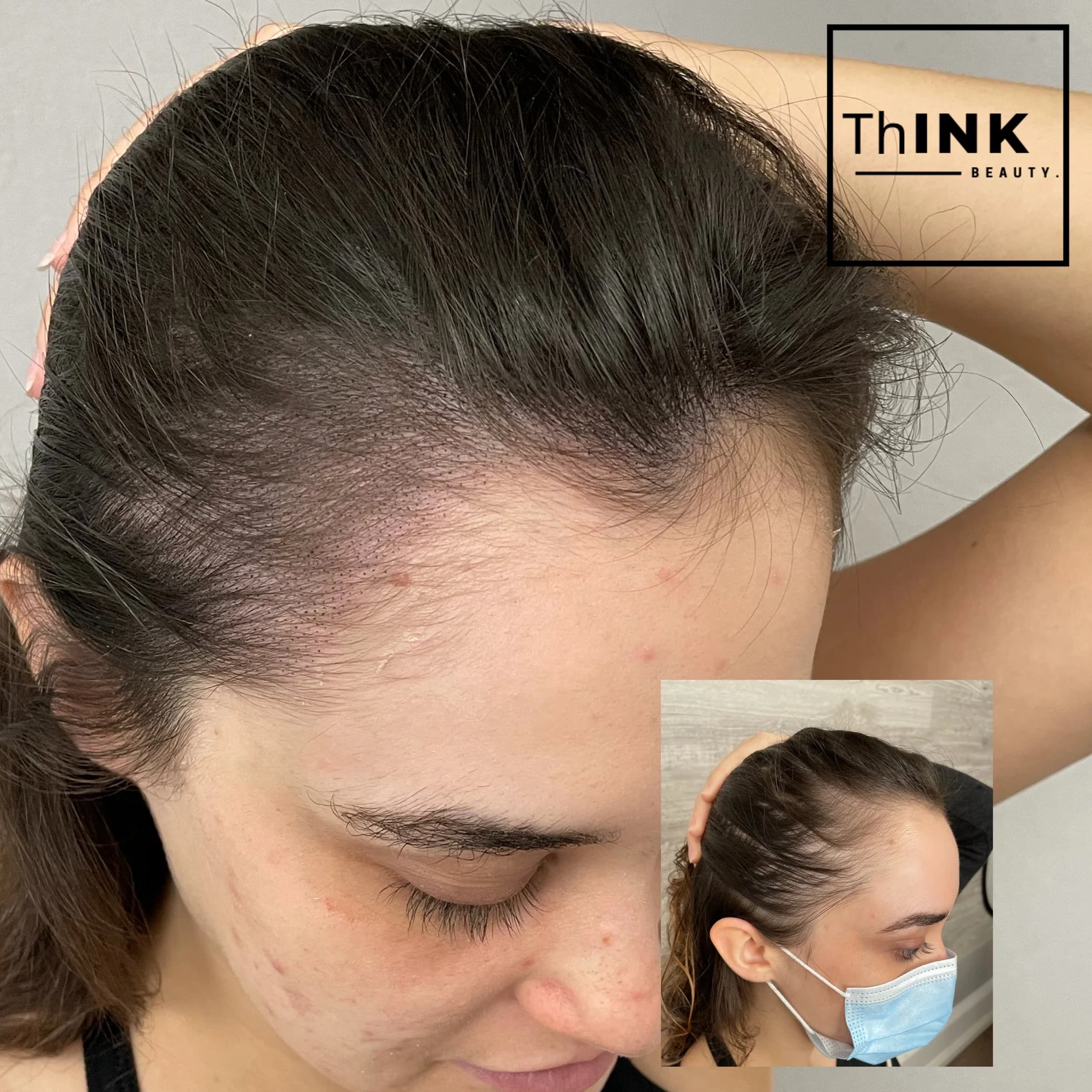 Female density result, hair reading fuller through the crown
