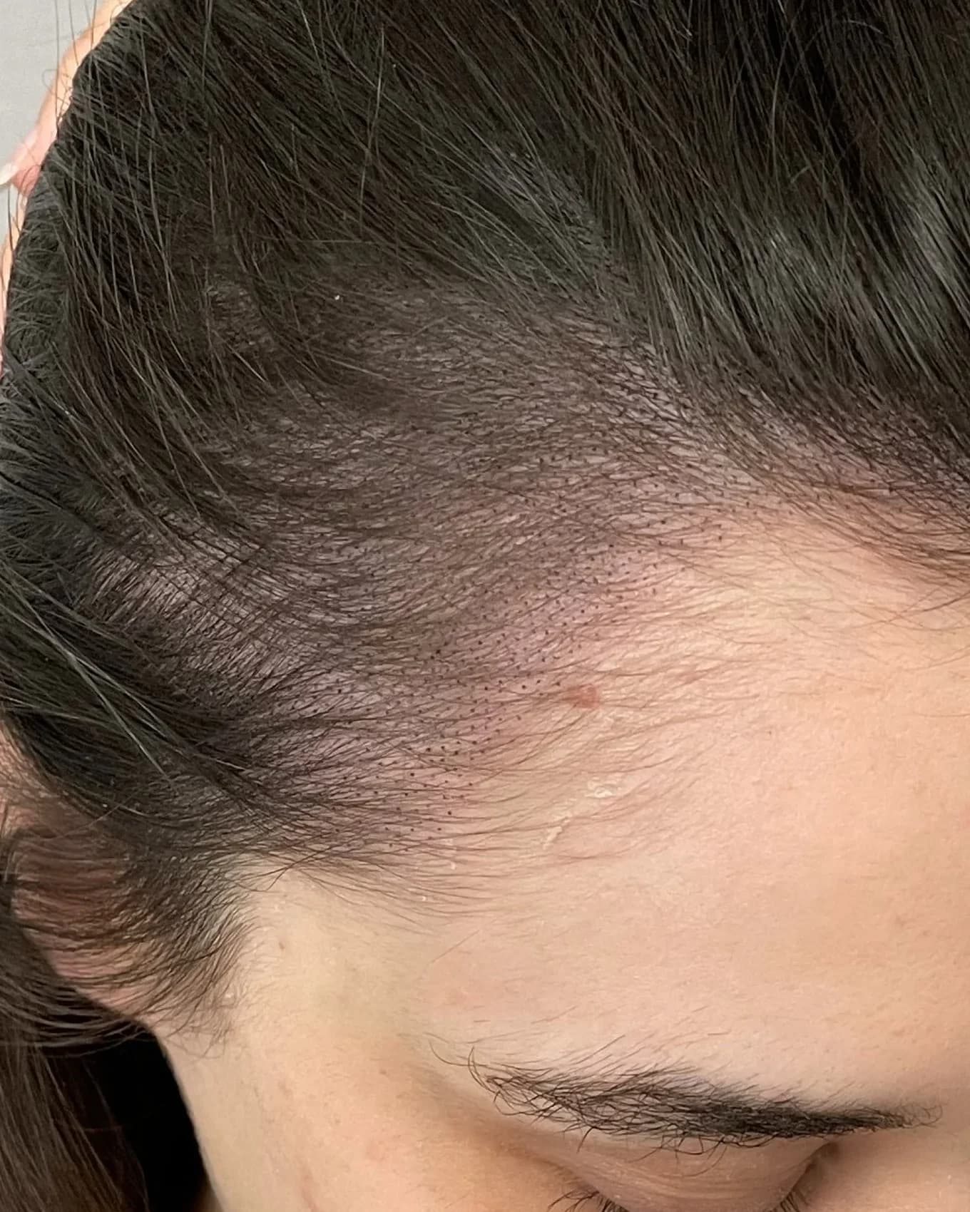 Female density scalp micropigmentation result showing a fuller-looking part