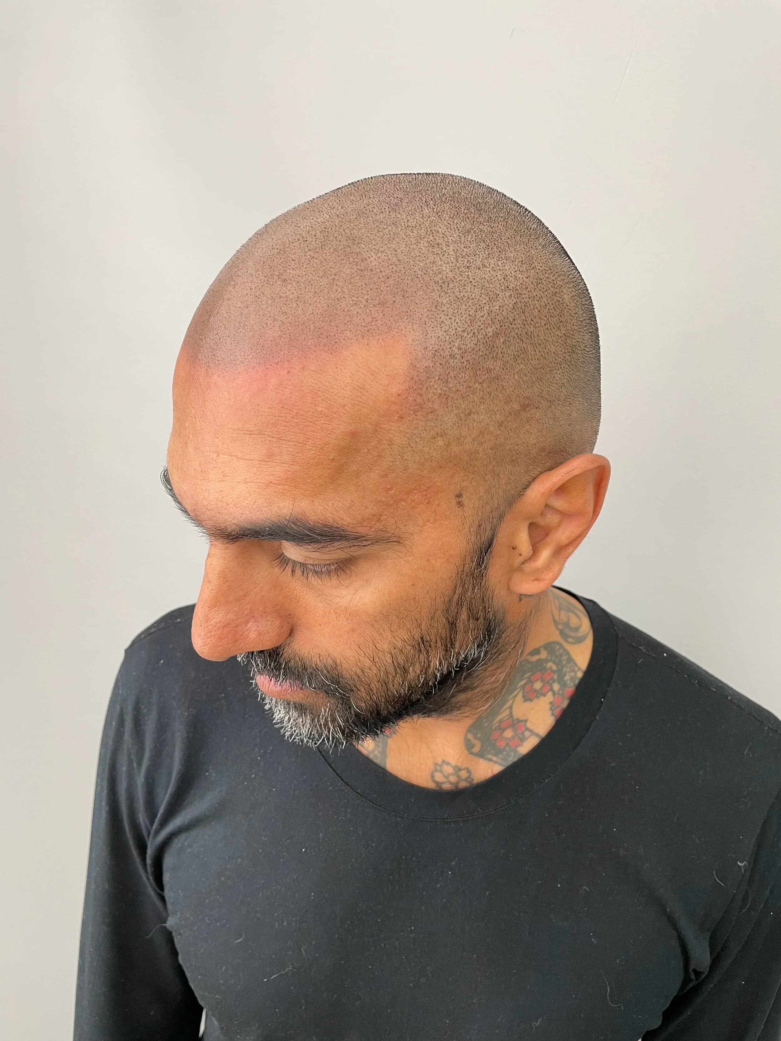 Scalp micropigmentation result with a natural, defined hairline