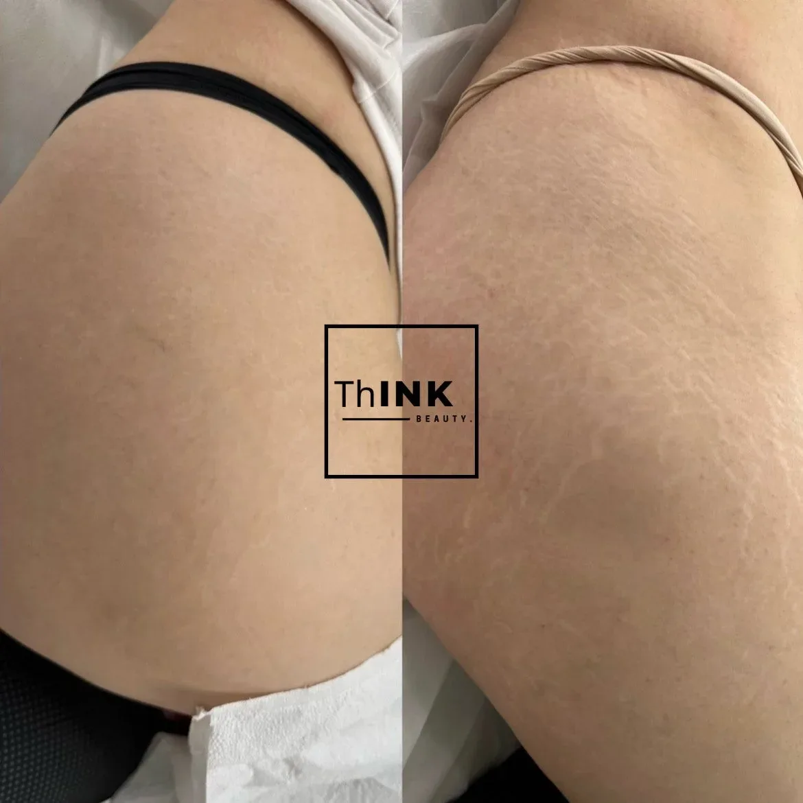 Stretch mark camouflage on the hip and thigh, before and after side by side