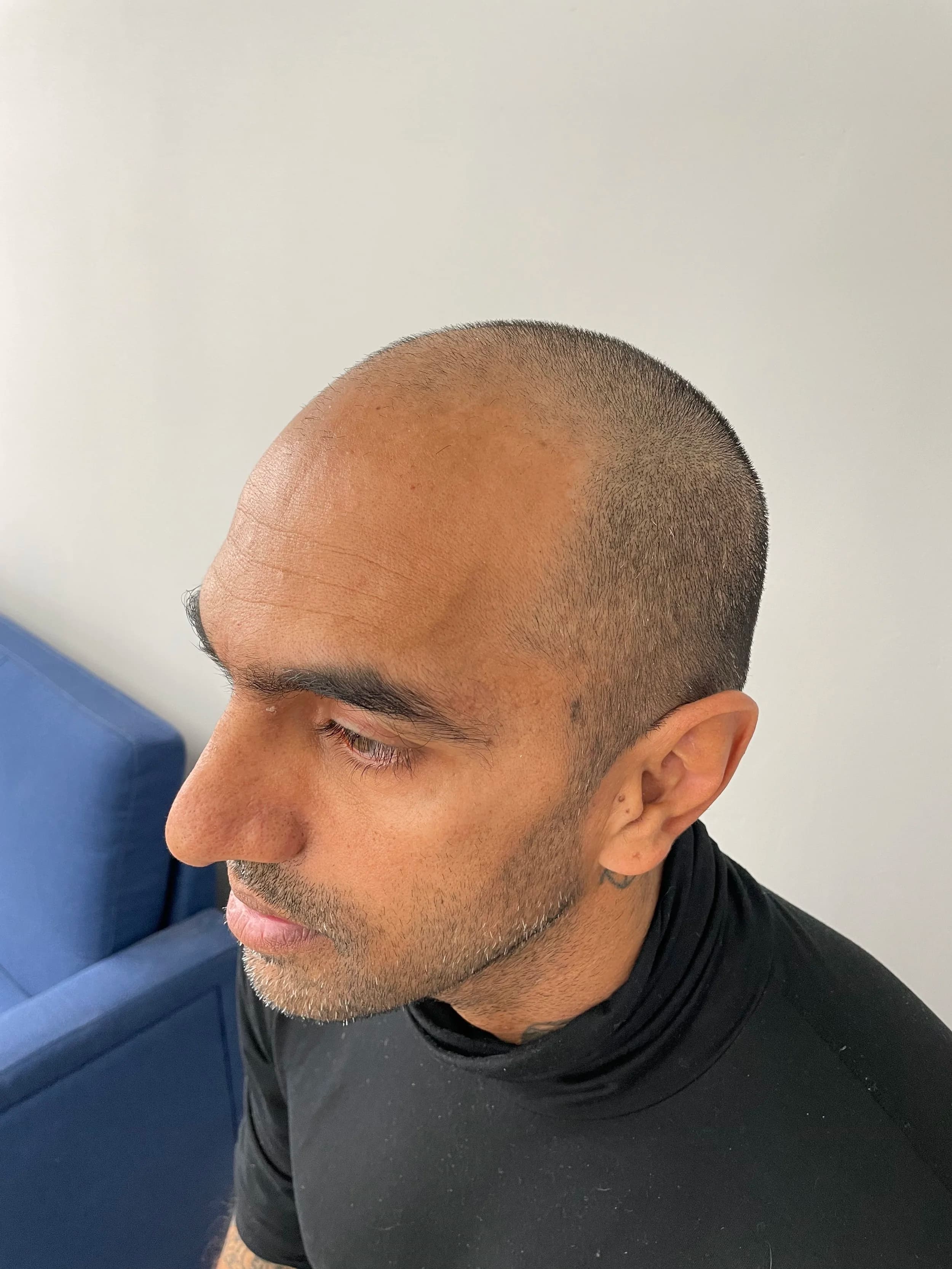Client before scalp micropigmentation treatment