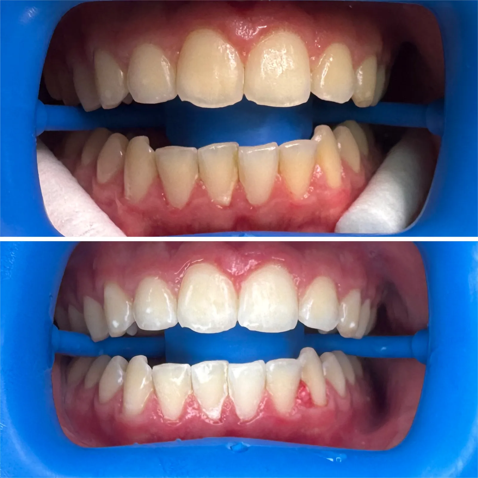A client's teeth before whitening, above the same smile visibly brighter after